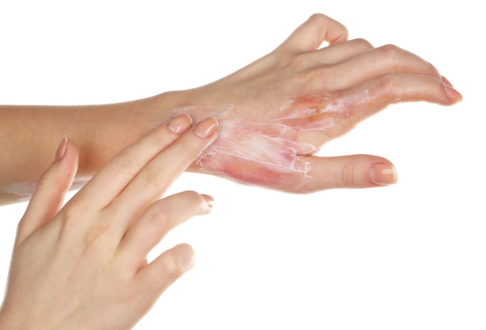 Preventing burn injuries Image of treatment for burns on a female hand isolated on white, featuring 411 Personal Injury Law and highlighting the importance of preventing burn injuries, ensuring it aligns with the page's context.